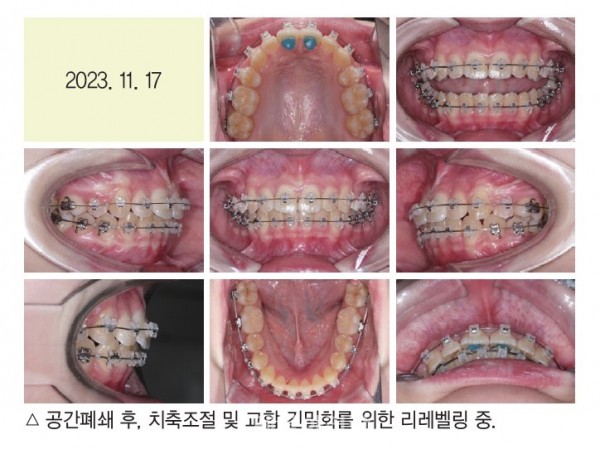 덧니 과개교합 교정 임상 5